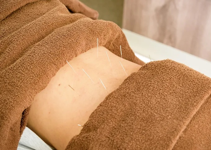 タオルで覆い、腰まわりに鍼の施術をしている様子